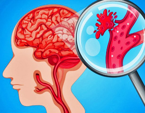 ACCIDENTE CEREBRO VASCULAR