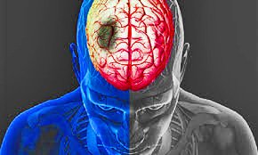 ACCIDENTE CEREBRO VASCULAR