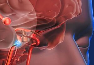 ACCIDENTE CEREBRO VASCULAR